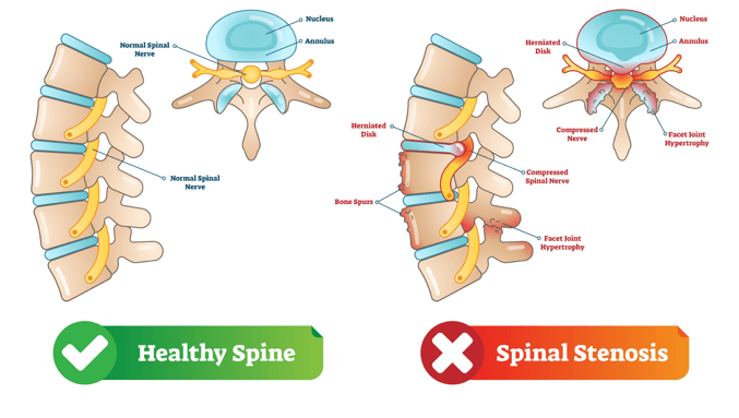Lumbar Spinal Stenosis Performance Medical Somerset County NJ